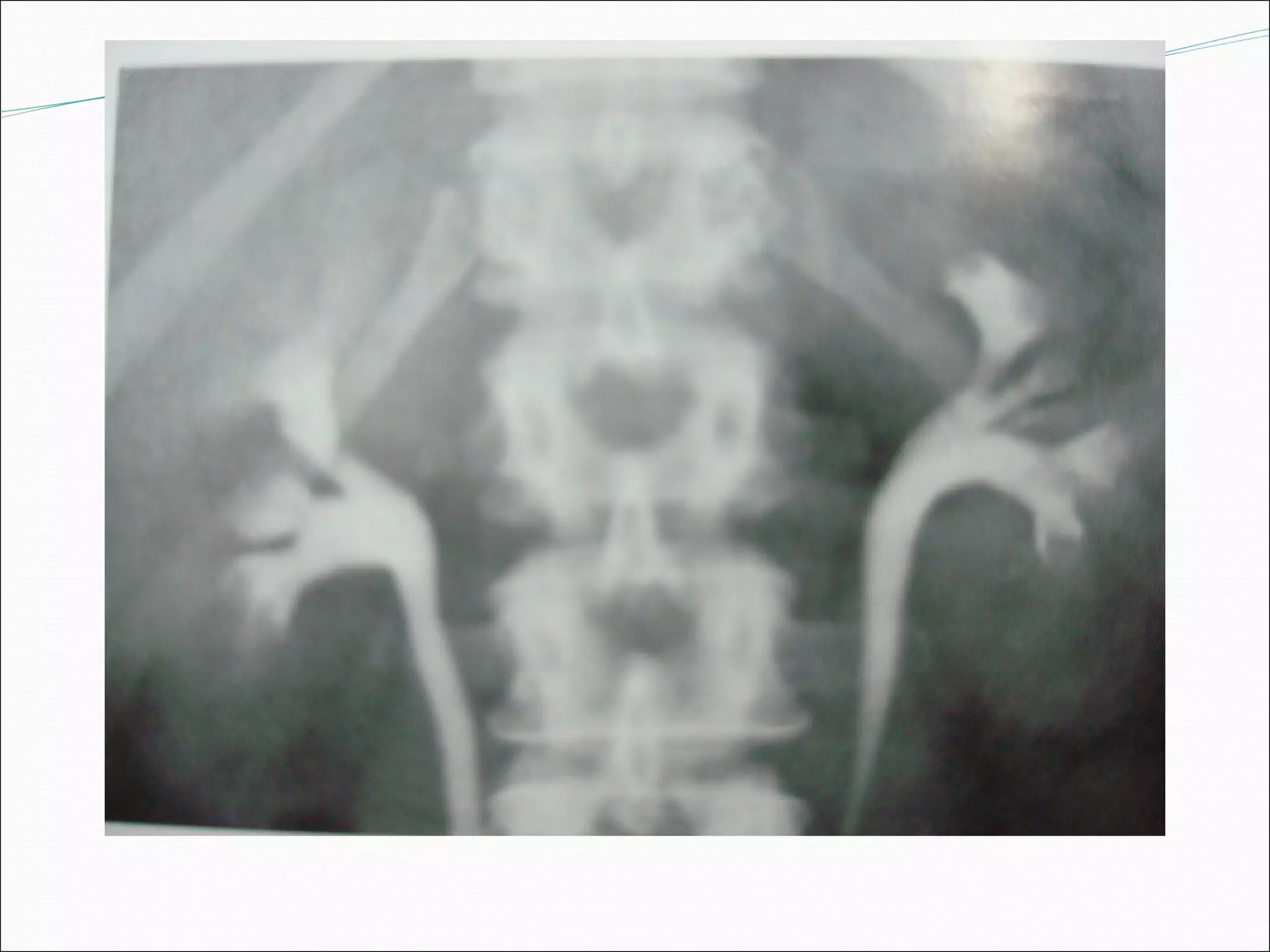 Intravenous urography (IVU) by Dr Bishnu Khatiwada, Conventional IVU ...