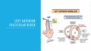 Intraventricular conduction block....... | PPTX