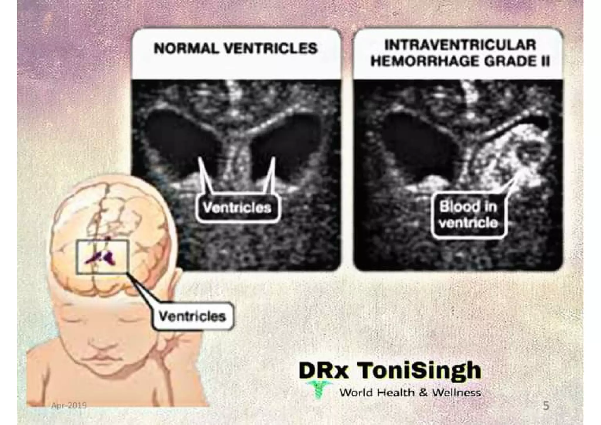 Intraventricular Hemorrhage Grades Intraventricular Hemorrhage