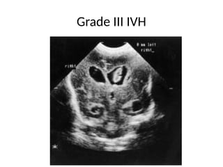 Diagnosis and management of Intraventricular hemorrhage in neonates | PPTX