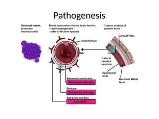 Diagnosis and management of Intraventricular hemorrhage in neonates | PPTX