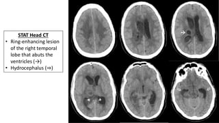Intraventricular Rupture Intraventricular Rupture of Brain Abscess (IVROBA).pdf
