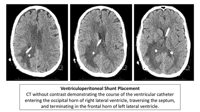 Intraventricular Rupture Intraventricular Rupture of Brain Abscess (IVROBA).pdf