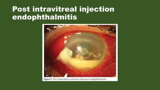 Post Intravitreal Injection Intravitreal injection | PPTX
