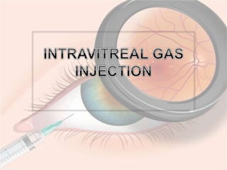 Intravit Injection Procedure Intravitreal injection | PPTX
