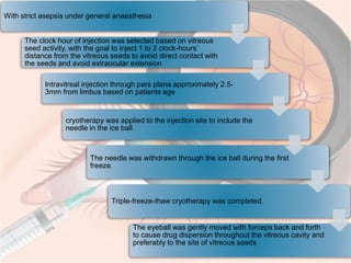 Intravit Injection Procedure Intravitreal injection | PPTX
