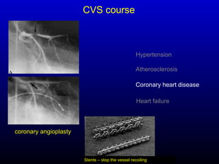 Hypertension
Atherosclerosis
Coronary heart disease
Heart failure
coronary angioplasty
CVS course
Stents – stop the vessel recoiling
 