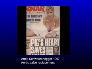 Arnie Schwarzenegger 1997 –
Aortic valve replacement
 
