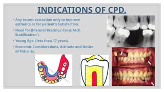 INTRO AND BIOMECHANIVCS OF CPD.pptx prostho | PPTX