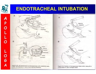 ENDOTRACHEAL IINNTTUUBBAATTIIOONN 
A 
P 
O 
L 
L 
O 
L 
O 
G 
A 
 