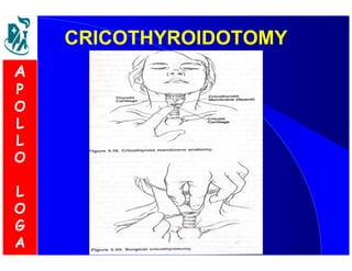 CCRRIICCOOTTHHYYRROOIIDDOOTTOOMMYY 
A 
P 
O 
L 
L 
O 
L 
O 
G 
A 
 