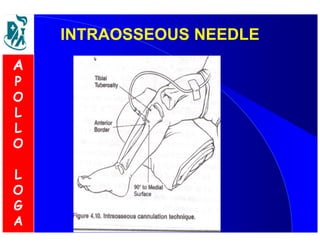 IINNTTRRAAOOSSSSEEOOUUSS NNEEEEDDLLEE 
A 
P 
O 
L 
L 
O 
L 
O 
G 
A 
 