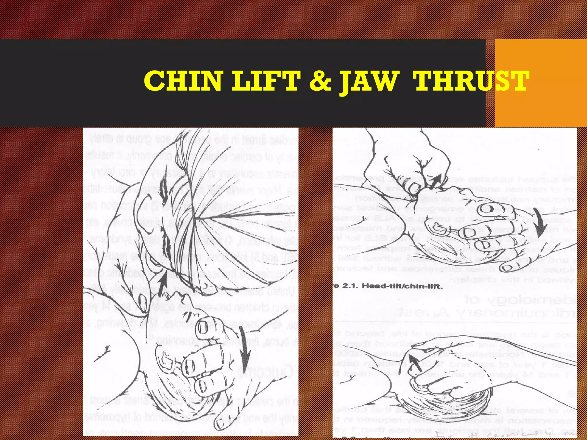 CHIN LIFT & JAW THRUST
 
