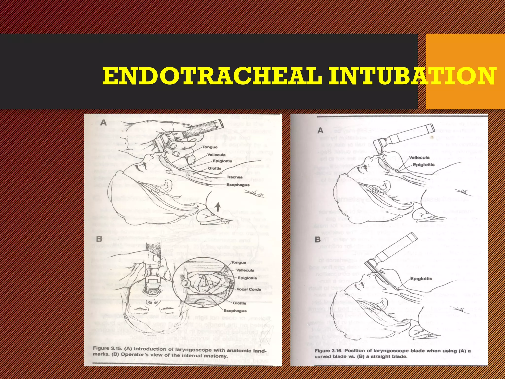 ENDOTRACHEAL INTUBATION
 