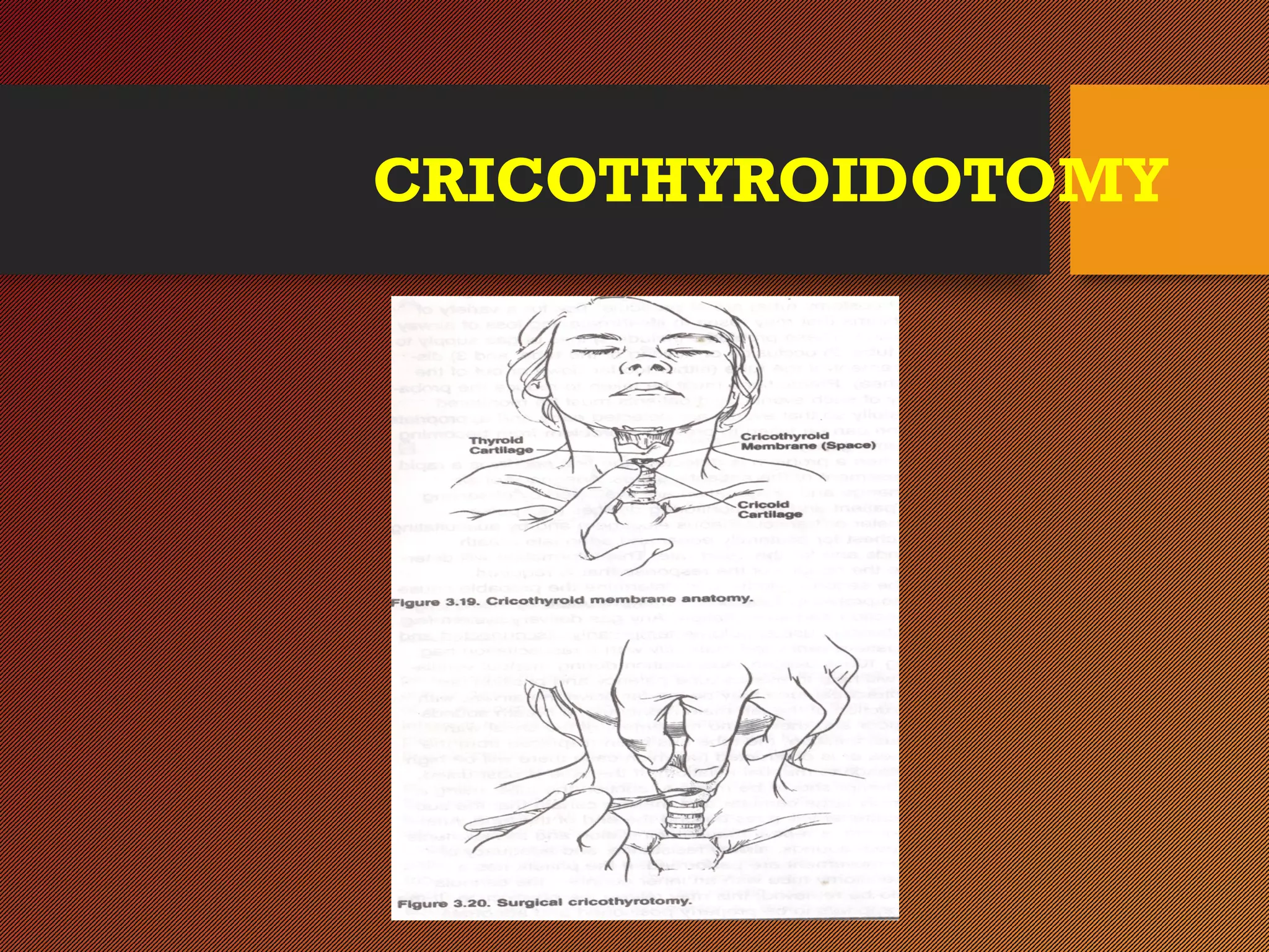 CRICOTHYROIDOTOMY
 