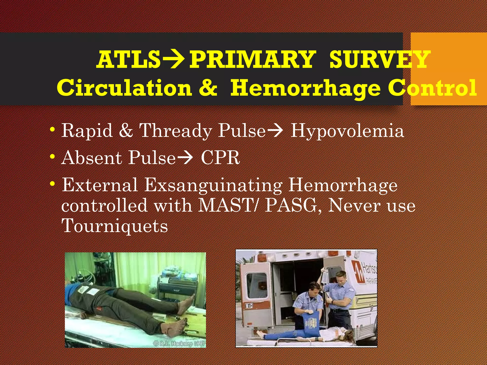 ATLSPRIMARY SURVEY
Circulation & Hemorrhage Control
• Rapid & Thready Pulse Hypovolemia
• Absent Pulse CPR
• External Exsanguinating Hemorrhage
controlled with MAST/ PASG, Never use
Tourniquets
 