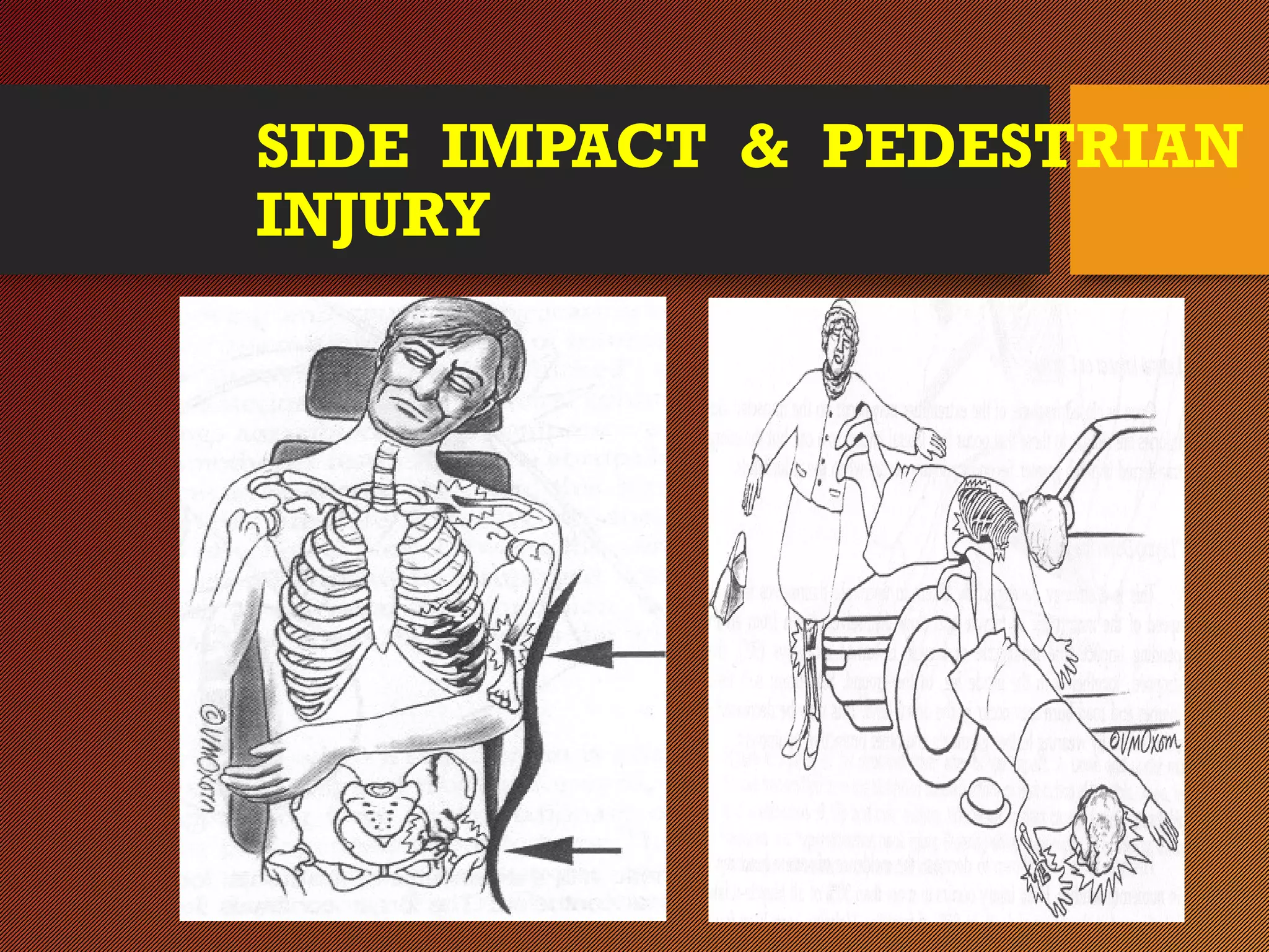 SIDE IMPACT & PEDESTRIAN
INJURY
 