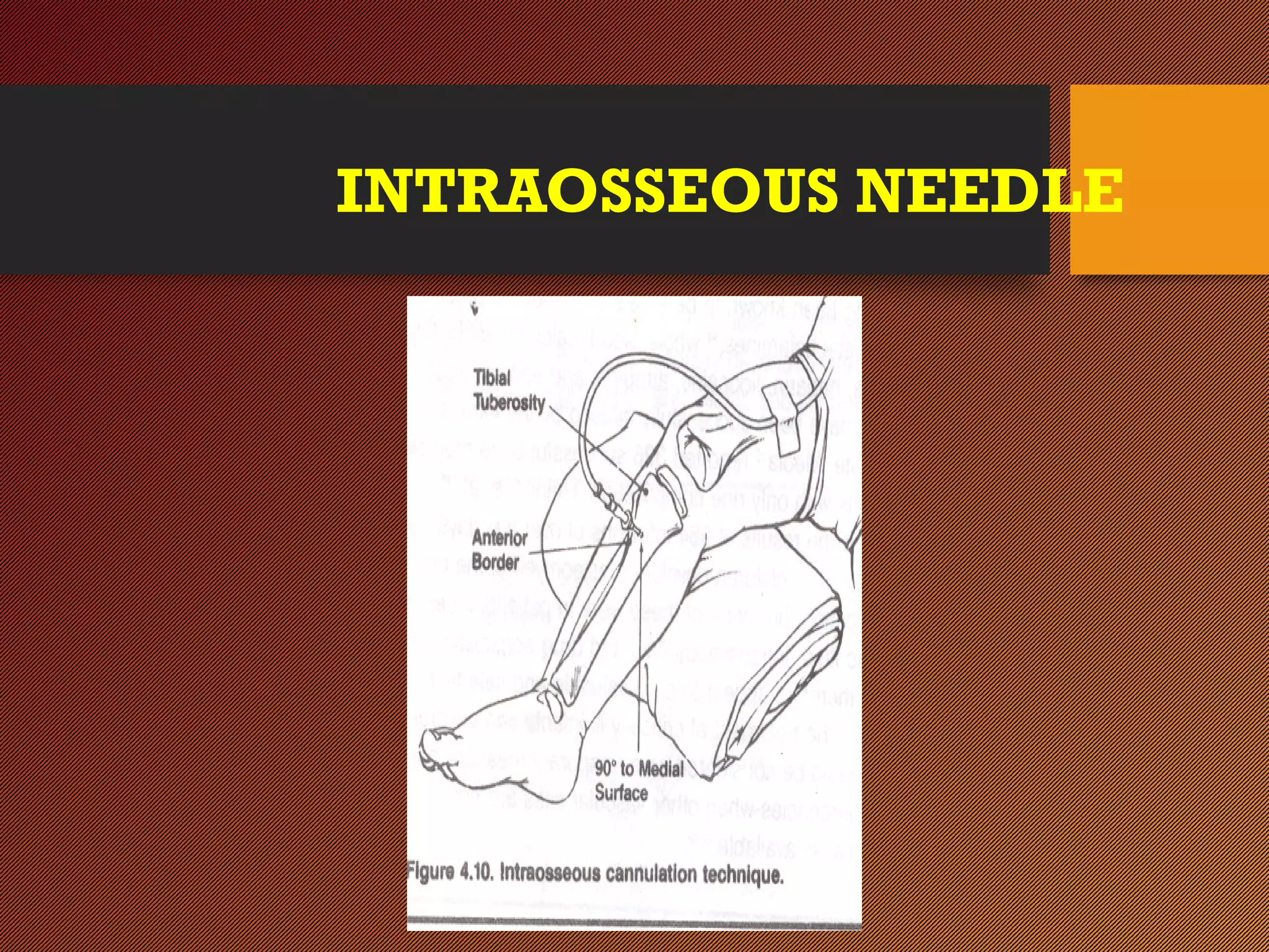 INTRAOSSEOUS NEEDLE
 