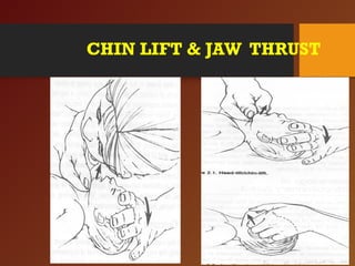 CHIN LIFT & JAW THRUST
 