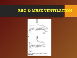 BAG & MASKVENTILATION
 