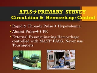 ATLSPRIMARY SURVEY
Circulation & Hemorrhage Control
• Rapid & Thready Pulse Hypovolemia
• Absent Pulse CPR
• External Exsanguinating Hemorrhage
controlled with MAST/ PASG, Never use
Tourniquets
 