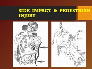 SIDE IMPACT & PEDESTRIAN
INJURY
 