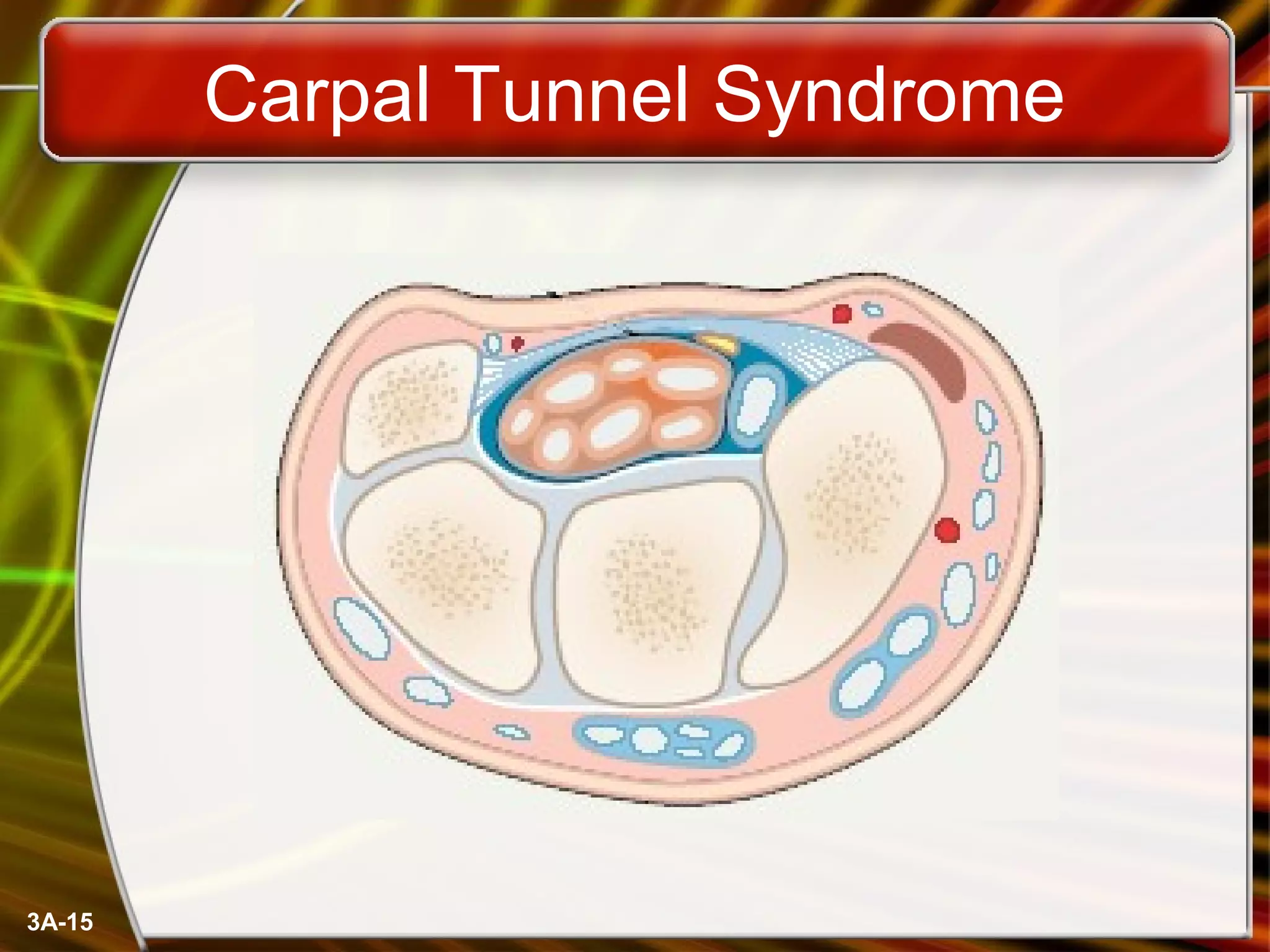 3A-15
Carpal Tunnel Syndrome
 