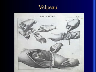 Velpeau
 