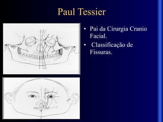 Paul Tessier
• Pai da Cirurgia Cranio
Facial.
• Classificação de
Fissuras.
 