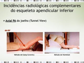Incidências radiológicas complementares
do esqueleto apendicular inferior
Axial PA
Axial PA do joelho (
do joelho (Tunnel
Tunnel View
View)
)
40-50º
40-50º
Método de Camp Coventry Método de Holmblad
 