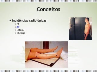 Conceitos
Incidências radiológicas
PA
AP
Lateral
Oblíqua
 