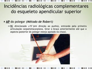 Incidências radiológicas complementares
do esqueleto apendicular superior
AP
AP do polegar (
(Método de Robert
Método de Robert)
)
RC
RC direcionado ±15°(em direção ao punho), entrando pela primeira
articulação carpometacarpiana. Girar o braço anteriormente até que o
aspecto posterior do polegar esteja apoiado no chassi.
15
º
 