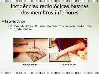 Incidências radiológicas básicas
dos membros inferiores
Lateral
Lateral do pé
RC
RC perpendicular ao PMS, orientado para o 10
cuneiforme medial (base
do 3º metatarsiano).
Médio-lateral
Médio-lateral Látero-medial
Látero-medial
 