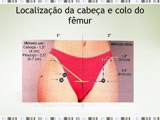 Localização da cabeça e colo do
fêmur
1º 2º
 