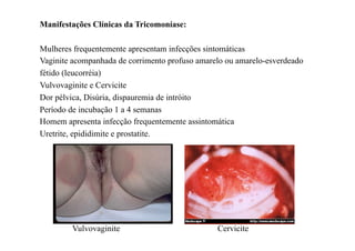 Manifestações Clínicas da Tricomoníase:

Mulheres frequentemente apresentam infecções sintomáticas
Vaginite acompanhada de corrimento profuso amarelo ou amarelo-esverdeado
fétido (leucorréia)
Vulvovaginite e Cervicite
Dor pélvica, Disúria, dispauremia de intróito
Período de incubação 1 a 4 semanas
Homem apresenta infecção frequentemente assintomática
Uretrite, epididimite e prostatite.




        Vulvovaginite                           Cervicite
 