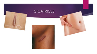 CICATRICES
 