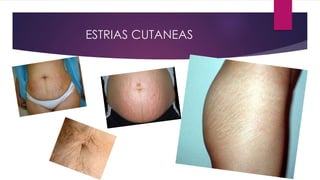 ESTRIAS CUTANEAS
 