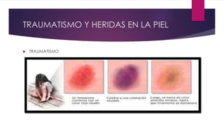 TRAUMATISMO Y HERIDAS EN LA PIEL
 TRAUMATISMO
 
