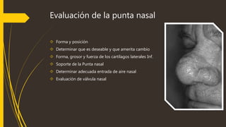 Evaluación de la punta nasal 
 Forma y posición 
 Determinar que es deseable y que amerita cambio 
 Forma, grosor y fuerza de los cartílagos laterales Inf. 
 Soporte de la Punta nasal 
 Determinar adecuada entrada de aire nasal 
 Evaluación de válvula nasal 
 