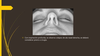  Con inspiración profunda, se observa colapso de ala nasal derecha, se deberá 
considerar previo a cirugía. 
 