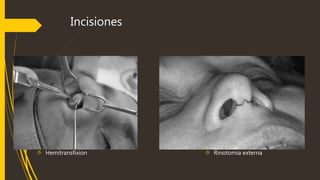 Incisiones 
 Hemitransfixion  Rinotomia externa 
 