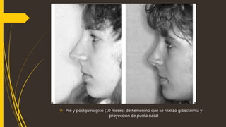  Pre y postquirúrgico (10 meses) de Femenino que se realizo gibectomia y 
proyección de punta nasal 
 