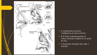  A: Usualmente la porción 
cartilaginosa se reseca primero 
 B: El hueso sobreporyectado se 
reseca, teniendo cuidado de no quitar 
de mas 
 C: Ilustración de legras tipo “jalar y 
empujar” 
 