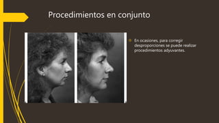 Procedimientos en conjunto 
 En ocasiones, para corregir 
desproporciones se puede realizar 
procedimientos adyuvantes. 
