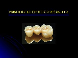 PRINCIPIOS DE PROTESIS PARCIAL FIJA
 