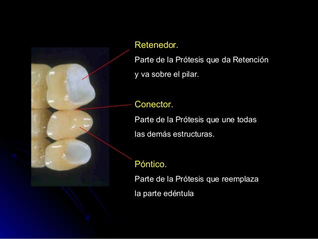 Tipos De Ponticos En Protesis Fija es.slideshare.net