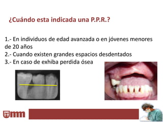 ¿Cuándo esta indicada una P.P.R.?

1.- En individuos de edad avanzada o en jóvenes menores
de 20 años
2.- Cuando existen grandes espacios desdentados
3.- En caso de exhiba perdida ósea
 