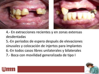 4.- En extracciones recientes y en zonas extensas
desdentadas
5.-En periodos de espera después de elevaciones
sinusales y colocación de injertos para implantes
6.-En todos casos libres unilaterales y bilaterales
7.- Boca con movilidad generalizada de tipo I
 