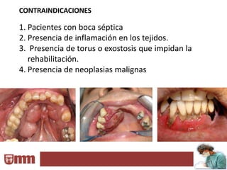 CONTRAINDICACIONES

1. Pacientes con boca séptica
2. Presencia de inflamación en los tejidos.
3. Presencia de torus o exostosis que impidan la
   rehabilitación.
4. Presencia de neoplasias malignas
 