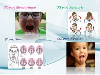 (IX par) Glosofaríngeo

(X par) Vago

(XI par) Accesorio

(XII par) Hipogloso

 